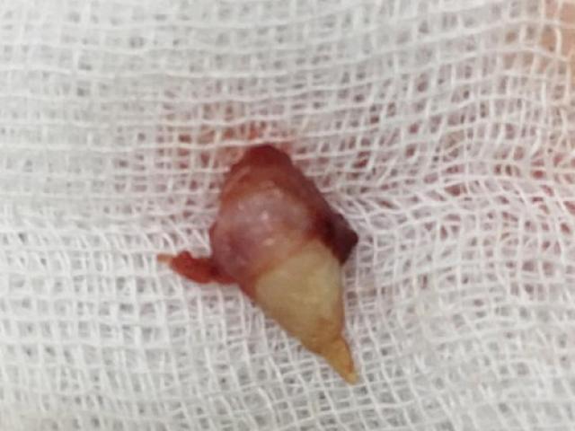 Sức khỏe đời sống - Hy hữu, bé gái 4 tuổi ở Hà Nội mọc răng trong mũi