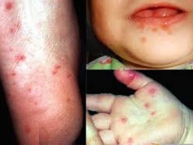 Bệnh chân tay miệng ở trẻ có tái phát không?