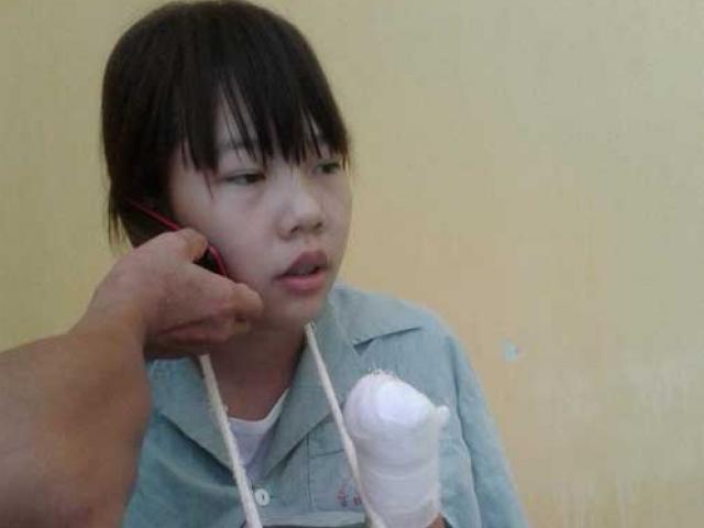 Nữ công nhân xinh đẹp bị máy dập nát đôi tay giờ ra sao?