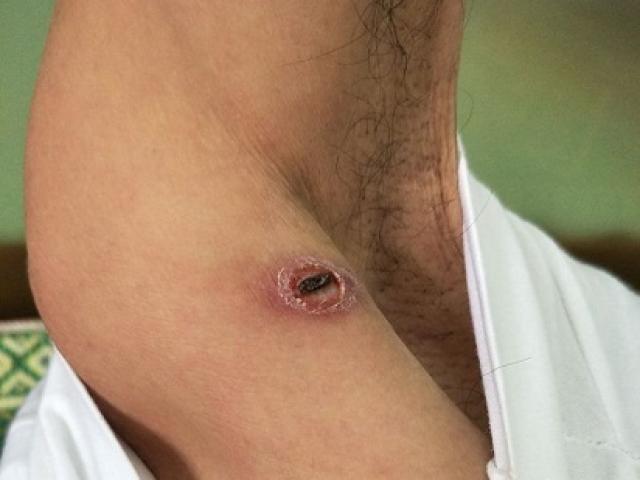 Sức khỏe đời sống - Sốt mò: Căn bệnh nguy hiểm dễ bị lãng quên