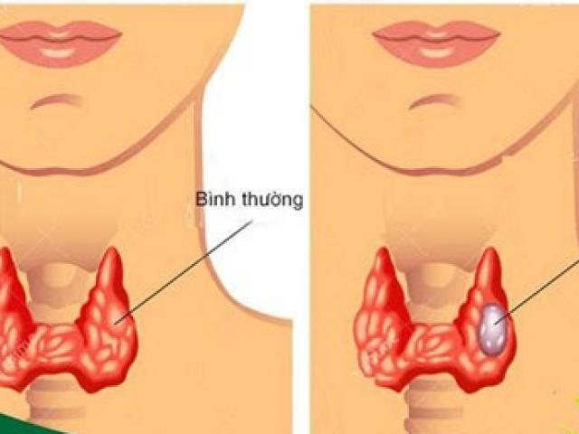 Sức khỏe đời sống - Phát hiện sớm ung thư tuyến giáp nhờ làm xét nghiệm này