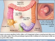 Sức khỏe đời sống - Bác sĩ Bệnh viện K chỉ ra “chìa khóa vàng” để chữa ung thư đại trực tràng