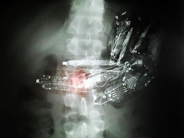 Thế giới - Brazil: Moi trong ổ bụng tù nhân ra... 10 cái điện thoại