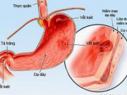 Sức khỏe đời sống - Tưởng con bị giun hoá ra viêm loét dạ dày vì lây vi khuẩn HP từ mẹ