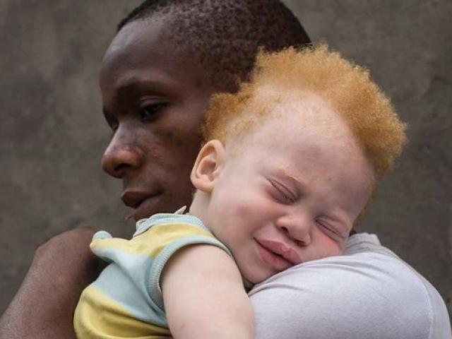 Thế giới - Những người sinh ra đã bị săn lùng chặt tay chân ở châu Phi