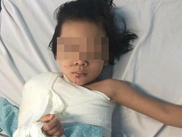 Nối thành công cánh tay bé gái 5 tuổi bị dập nát sau tai nạn giao thông