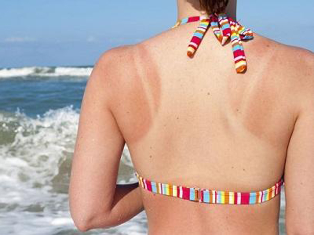 Bí quyết làm đẹp - Những điều cần biết để “cấp cứu” làn da cháy nắng