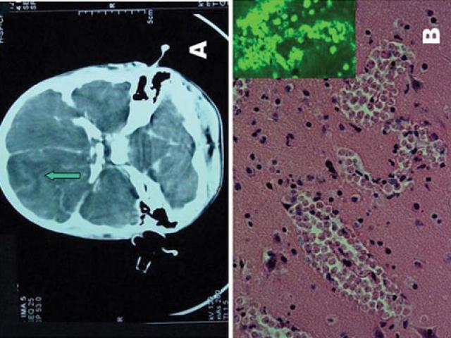Sức khỏe đời sống - Thiếu nữ tử vong vì bị amip "ăn não” khi đi bơi