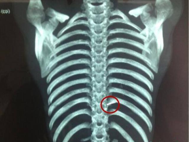 Sức khỏe đời sống - Cứu sống em bé có chiếc kim dài 5 cm nằm gần tim