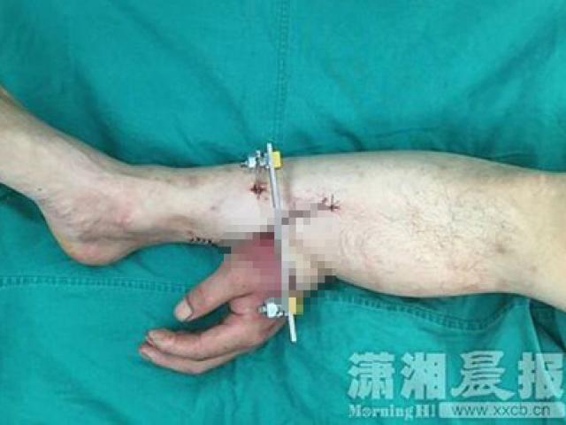 Sức khỏe đời sống - Hi hữu: Phẫu thuật nối tay vào chân