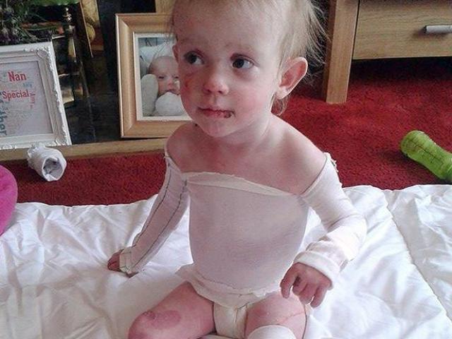 Sức khỏe đời sống - Xót xa bé gái mắc bệnh da cánh bướm khiến mẹ không dám ôm