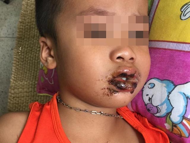 Sức khỏe đời sống - Ăn nhầm bột thông cống ở nhà trẻ, 4 cháu bé cấp cứu