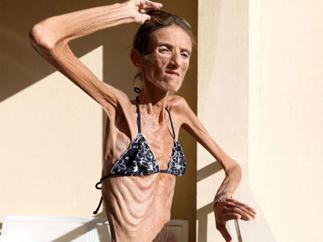 Làm đẹp - Thiếu nữ "da bọc xương" mặc bikini gây xôn xao