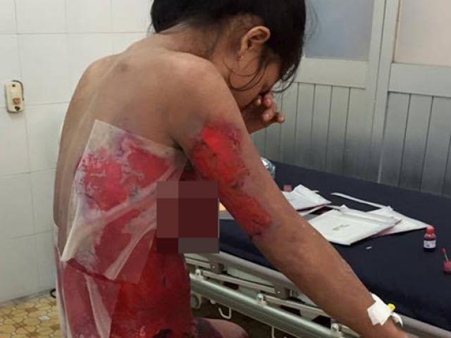 Sức khỏe đời sống - Nguy kịch vì tự mua thuốc điều trị 2 vết cắn của bọ cạp