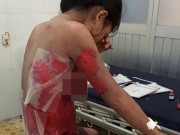 Sức khỏe đời sống - Nguy kịch vì tự mua thuốc điều trị 2 vết cắn của bọ cạp