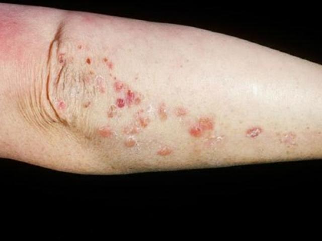 Sức khỏe đời sống - Các nguyên nhân khó ngờ gây bệnh cho da