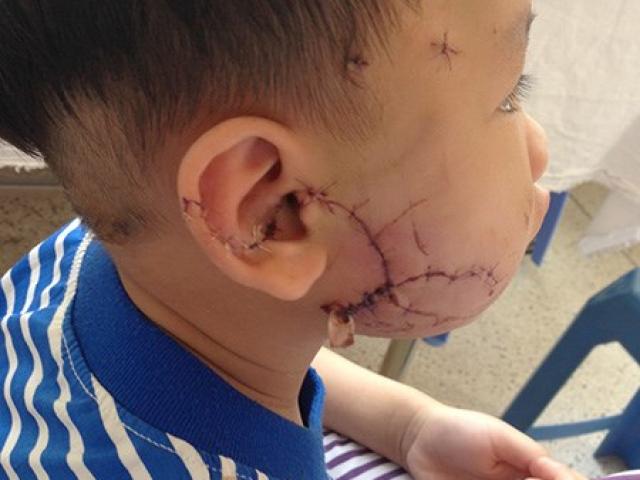 Sức khỏe đời sống - Hàng loạt trẻ nhập viện vì chó cắn