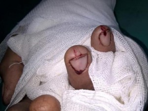 Tin tức trong ngày - Đứt 3 ngón tay vì nổ bánh xe khi bơm