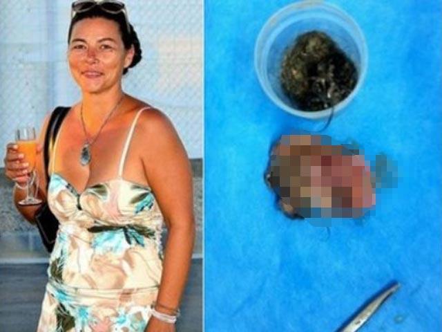 Sức khỏe đời sống - Hi hữu, người phụ nữ "mang thai" chị em song sinh hơn 40 năm