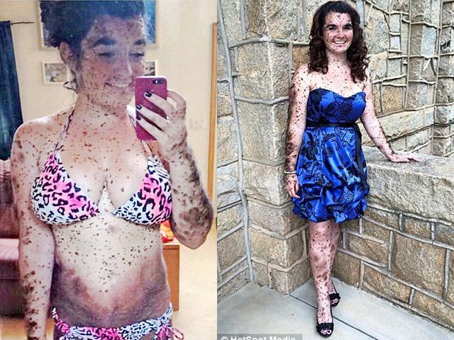 Làm đẹp cùng sao - Thiếu nữ xinh đẹp bị xa lánh vì có làn da đầy tì vết