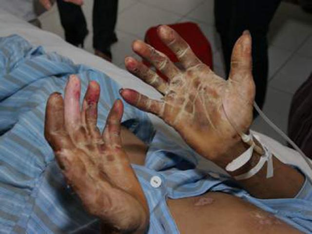 Sức khỏe đời sống - Đồng Nai: Xuất hiện ca nhiễm liên cầu khuẩn lợn đầu tiên