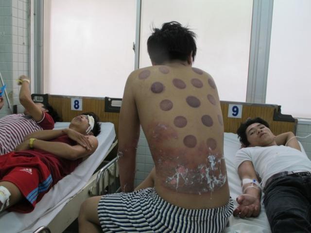Sức khỏe đời sống - Giác hơi, mẹ vô ý "đốt cháy" con