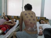 Sức khỏe đời sống - Giác hơi, mẹ vô ý &quot;đốt cháy&quot; con