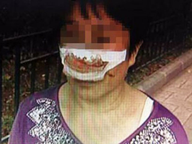 Tin tức trong ngày - TQ: Chồng cắn đứt mũi vợ vì không trả lời điện thoại