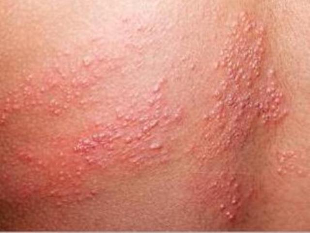 Sức khỏe đời sống - Nguyên nhân và triệu chứng của bệnh Zona thần kinh