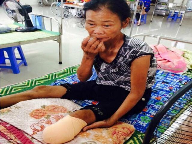 Sức khỏe đời sống - Một tuần bị nhọt, nhập viện bị cắt chân ngay lập tức