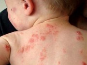 Sức khỏe đời sống - Những điều cần kiêng kỵ tuyệt đối khi mắc zona thần kinh