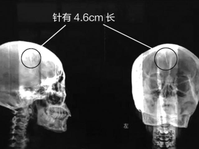 Sức khỏe đời sống - Sốc khi phát hiện chiếc kim dài gần 5cm kẹt trong não hàng chục năm