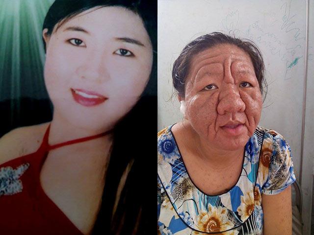 Sức khỏe đời sống - Cô gái 29 tuổi hóa bà lão 70 là nạn nhân của corticoid