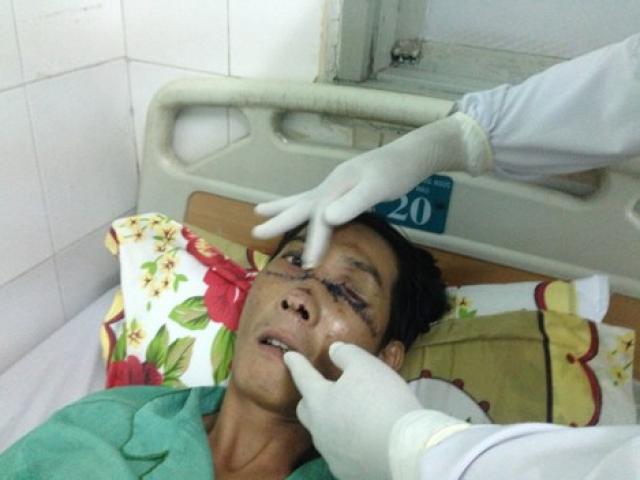 Sức khỏe đời sống - Cứu sống bệnh nhân gãy đôi xương mặt vì nổ bánh "xe rùa"