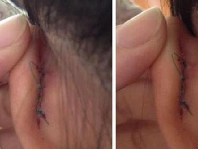 Giáo dục - du học - Bị cô giáo véo tai, học sinh lớp 2 phải khâu 2 mũi