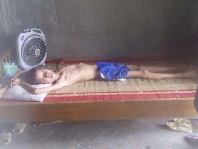 Bạn trẻ - Cuộc sống - Xót xa ước mơ của cậu bé "xác ướp" nặng 15kg ở Thái Nguyên