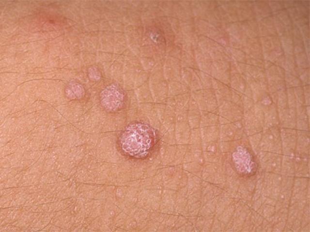 Sức khỏe đời sống - Nữ sinh khóc toáng ở phòng khám khi biết mình mắc sùi mào gà