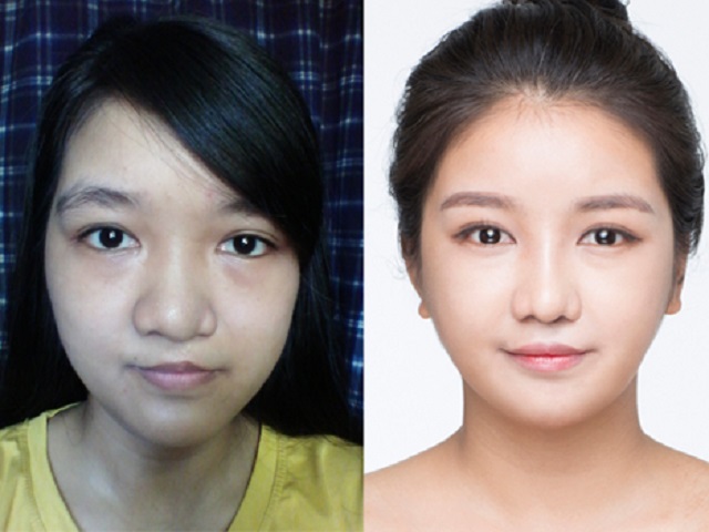 Bất ngờ với nụ cười đẹp của 2 cô gái Việt từng sứt môi