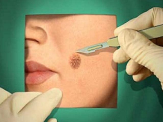 Sức khỏe đời sống - "Lợn lành thành lợn què" vì tự tẩy nốt ruồi bằng tỏi tại nhà