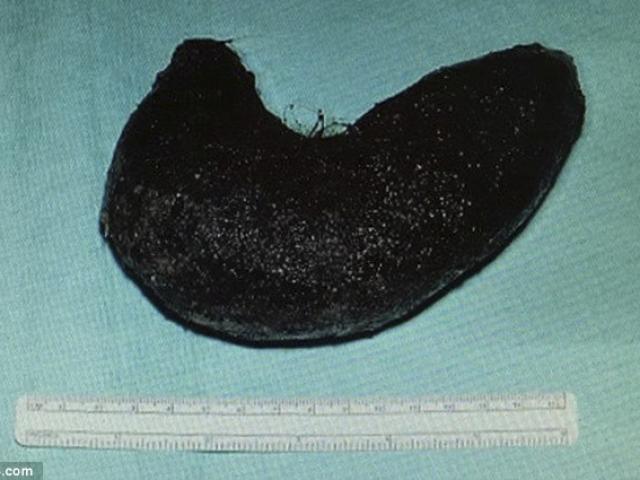 Phi thường - kỳ quặc - Bà mẹ nuốt hơn 6kg tóc vào bụng lúc ngủ