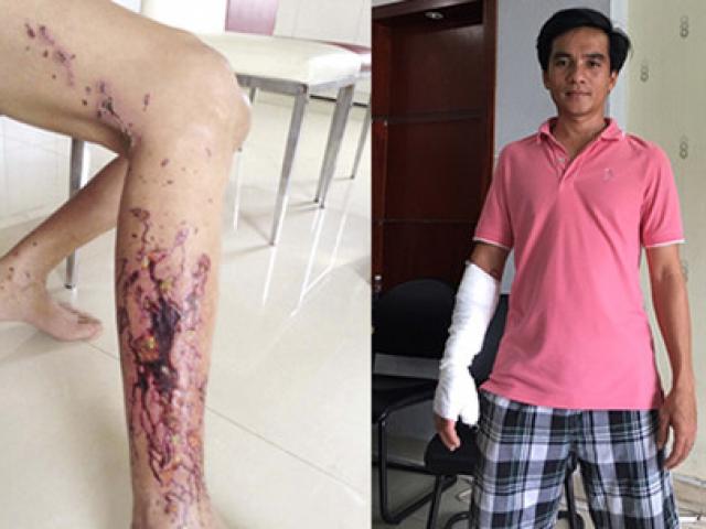 Sức khỏe đời sống - Bỏng tay, hoại tử chân vì chất thông cống