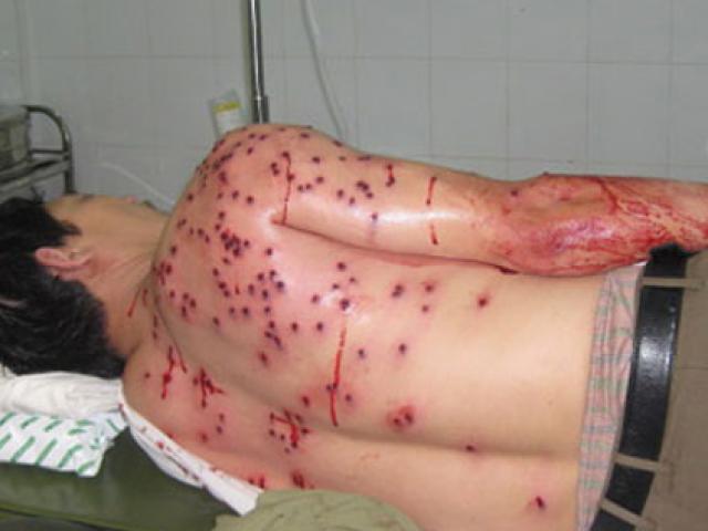 Pháp luật - Bắt kẻ bắn hai người dính 15 viên đạn bi