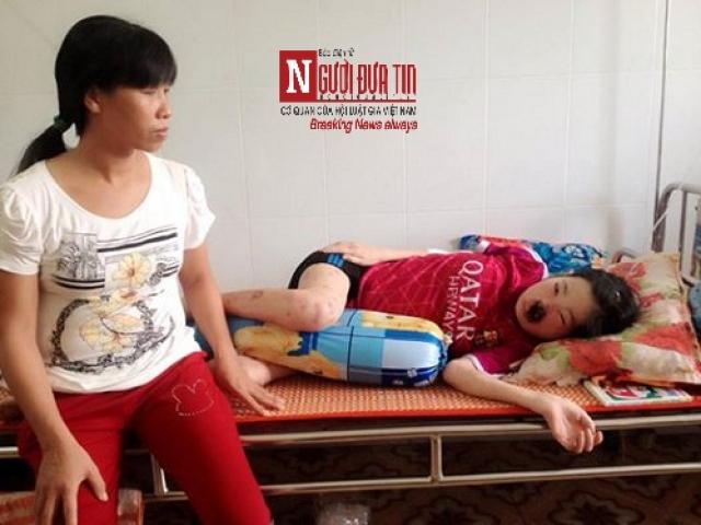 Bạn trẻ - Cuộc sống - Cô gái xinh xắn bỗng lở loét toàn bộ vùng mặt mũi