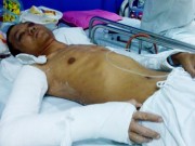 Pháp luật - Côn đồ truy sát, đánh gãy tay người uống nước ở vỉa hè