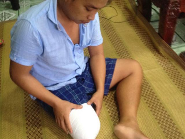 Tin tức trong ngày - Vụ bệnh nhân bị cưa chân ở TP.HCM: "Đứt gánh" giấc mơ