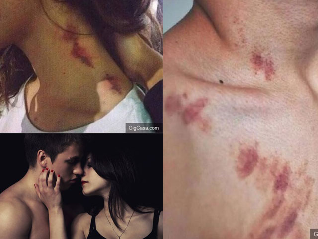 Bạn trẻ - Cuộc sống - Mẹ hoảng loạn khi thấy "vết yêu" trên người con gái