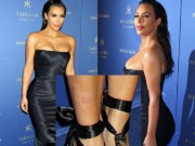 Người mẫu - Hoa hậu - Kim Kardashian đau đớn, da xấu vì mắc bệnh vảy nến