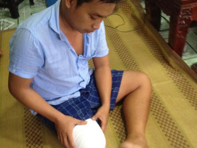 Tin tức trong ngày - Vụ bệnh nhân bị cưa chân: Gia đình "đòi" bồi thường ra sao?