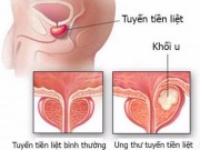 Sức khỏe đời sống - 10 căn bệnh ung thư có nguy cơ cao với nam giới