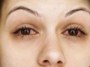 15 nguyên nhân khiến mắt bạn thường xuyên bị đỏ